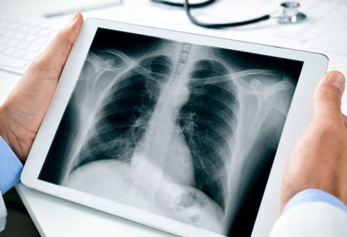 chest-x-ray_thumb-1-732×549 chest-x-ray_thumb-1-732x549